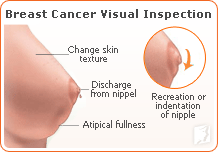 Breast Cancer Symptoms Pictures Nipple