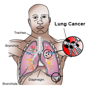 Lung Cancer Signs And Symptoms
