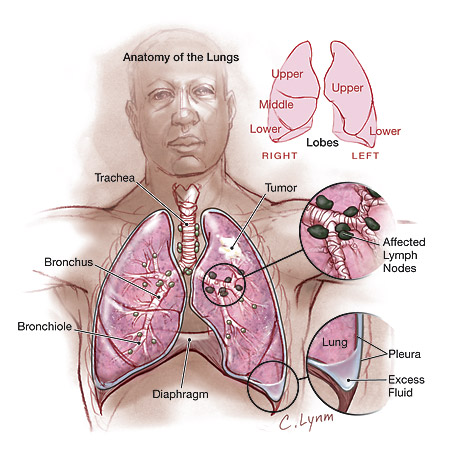 Lung Cancer Signs And Symptoms In Women