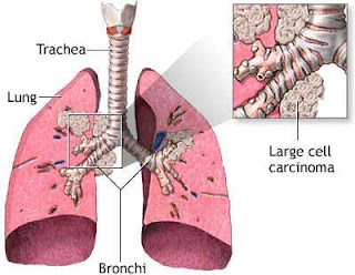 Lung Cancer Symptoms In Women