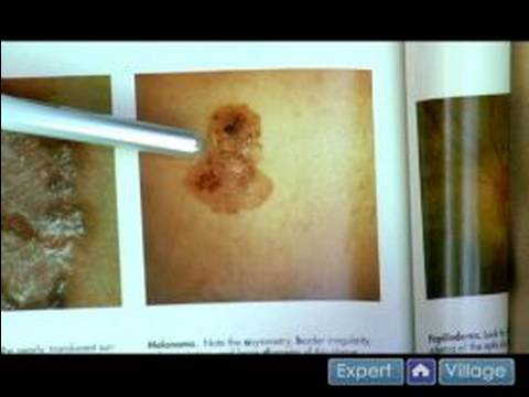 Melanoma Skin Cancer Symptoms Pictures
