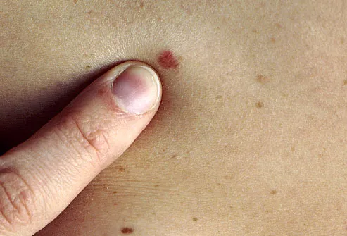 Melanoma Skin Cancer Symptoms Pictures