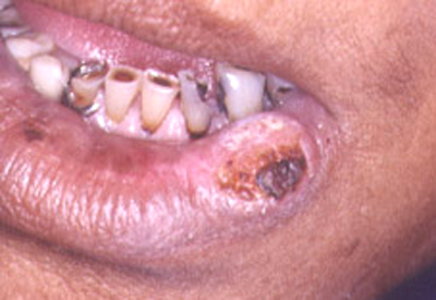 Mouth Cancer Symptoms From Dipping