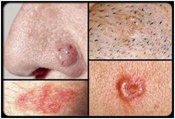 Skin Cancer Signs And Symptoms Pictures