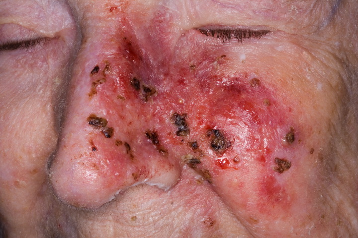 Skin Cancer Symptoms Photos