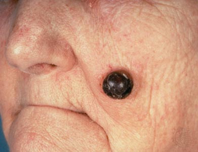 Skin Cancer Symptoms Pictures