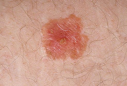 Skin Cancer Symptoms Pictures And Signs