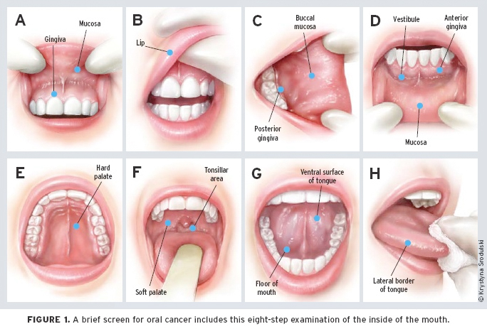 Tongue Cancer Symptoms And Signs Pictures