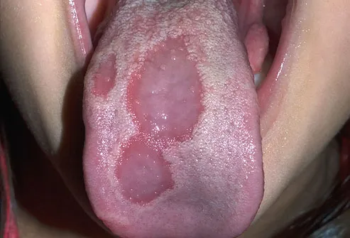 Tongue Cancer Symptoms Mayo Clinic