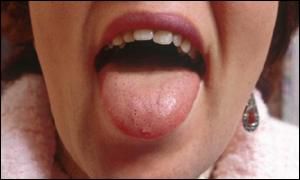 Tongue Cancer Symptoms Photos